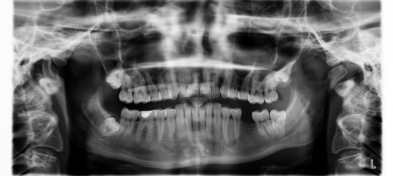 x ray 961977 1280 - Pornographie